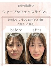 ヨサパーク アタ 中目黒店(YOSA PARK ATHA)/1回施術後 before→after写真