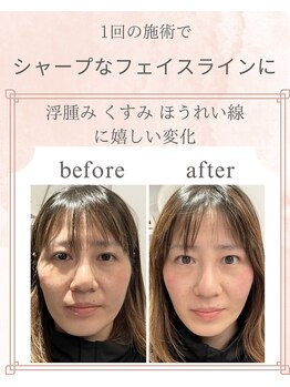 ヨサパーク アタ 中目黒店(YOSA PARK ATHA)/1回施術後 before→after写真