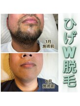 ウパラギンザ(Upala Ginza)/ひげW脱毛で徹底脱毛♪