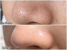 エミマス ボーテ(Emimas Beaute’)/毛穴洗浄×毛穴引き締めマスク