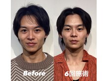 コルミチョン サロン(骨美整 salon)/メンズ小顔矯正　Before・After