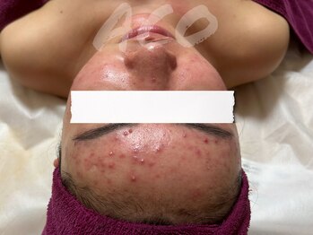 スキンケアスタジオ アコ 新宿店(Aco)/ニキビ/跡/肌荒れ/GPソフト１D前