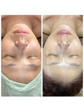 サロン フィオーレ(salon fiore)/もちもちツヤ肌　ピーリング