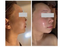 ニコ(NIKO)の雰囲気（キュッと引き締めハリ肌へ♪小顔＆たるみケアのダブルアプローチ）