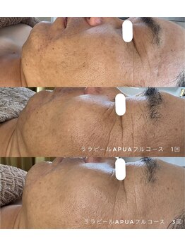 カウニス るる(kaunis)/【ララピール】Before After