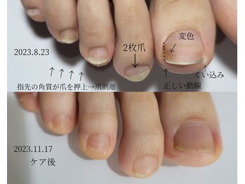 阿良波々岐(アラハバキ)/≪フットケア≫二枚爪・変色の爪