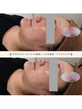 ディアー(Dear)/プラズマパールリフト