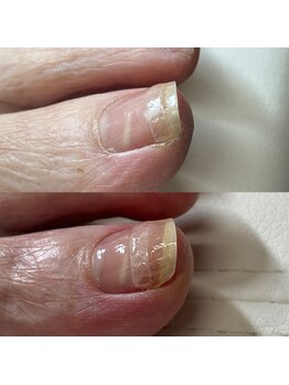 リリ(lili)/巻き爪矯正2回目(左親指)