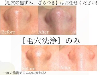 くすくす/毛穴黒ずみ、ざらつき、開きには