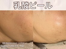 ポレ サロ(pore salo)/【乳酸ピール｜毛穴｜開き】