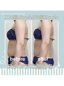 ハロ 南青山(HALO)/お腹+二の腕スタンプ二層打ち