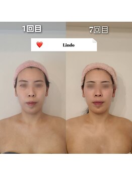 リンド(Lindo)/韓国発祥　小顔矯正コルギ