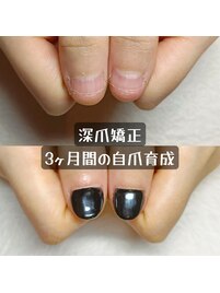 深爪矯正のアクリルスカルプ