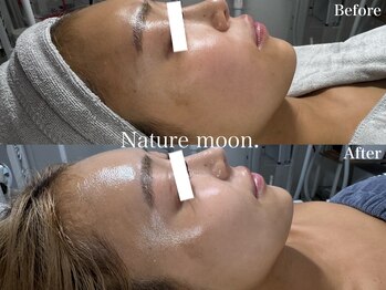 ナチュールムーン(Nature moon.)/ハーブピーリン after