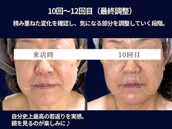 ジュジュ(juju)の写真/【たるみ、ほうれい線、二重あご、頬コケ、毛穴などでお悩みの方に】めざせ自分史上最高のリフトアップ小顔