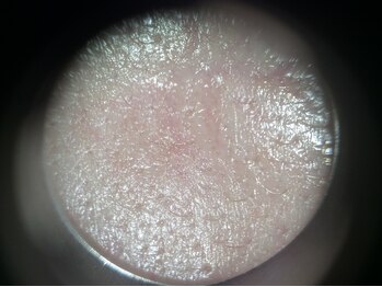 メナードフェイシャルサロン 浜北駅前/エステ後のきれいになった毛穴！