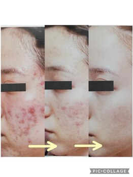 RiとBiのたまご/(フェイシャル)　ニキビケア