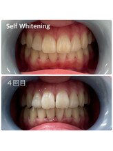 スカイ(Sky)/ホワイトニング