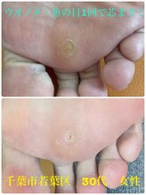 巻き爪じゅん 千葉駅前店/ウオノメ１回で芯まで取れた！