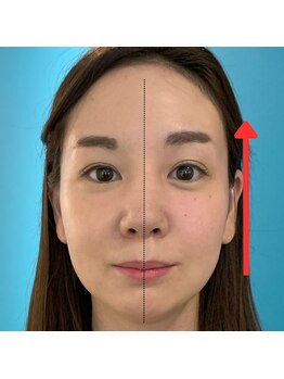 ネクスフィット(Nexfit)/小顔矯正フェイスリフトの効果