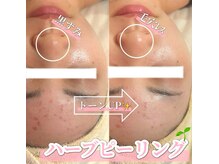 サロン(SALON)/ハーブピーリング