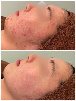 ビオプラス(BioPlus+)/ハーブピーリング/川崎