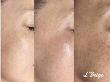 レ ベージュ(L’Beige)/リアボーテ肌質改善フェイシャル