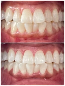 ルフレ(Reflet)/S6~S8の白さが叶う☆