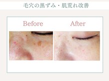 トータルビューティー ゆみえエステ(Total Beauty)/OHLハーブピーリング