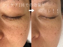 サロンドシエル カスガイ(Salon de Ciel kasugai)/シミケア1回での効果がコレ！！