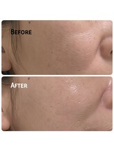 アイドット(i...)/たるみ改善♪毛穴ケアに☆