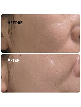 アイドット(i...)/たるみ改善♪毛穴ケアに☆