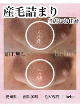 ベベ(bebe)/黒ずみ？いいえ、産毛です