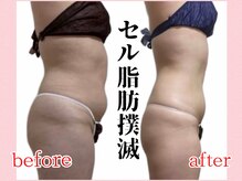 ウィズルーチェ 神栖店(with luce)の雰囲気（40代・お腹のセルライトが気になりご来店。お腹周りを中心に施術）