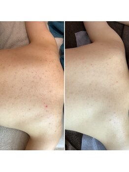 エステティックサロン S/背中トリートメント4回目