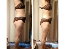 サクラス(SUQRAS)/ビフォーアフター/5回