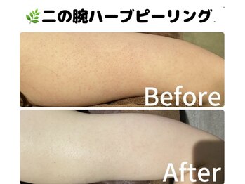 ホワイトアクア 柏店(WHITE AQUA)/二の腕ケア/ボディケア/赤みケア