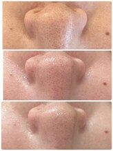 【 シミ・毛穴根本改善フェイシャル 】Myubelle-ミュベル-/小鼻の根本改善