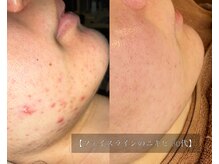 ル シーニュ/プロセルフェイシャル×5回