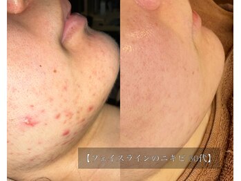 ル シーニュ/プロセルフェイシャル×5回