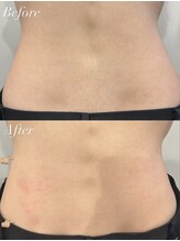 ジョエルワックス 沖縄那覇店(JOELLE WAX)/自己処理のいらない腰まわりに♪