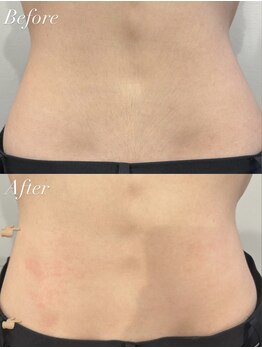 ジョエルワックス 沖縄那覇店(JOELLE WAX)/自己処理のいらない腰まわりに♪