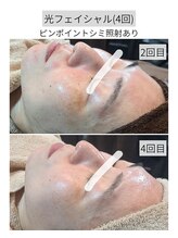 アースコアフュールボーテ ひたち野うしく店(EARTH coiffure beaute)/光フェイシャル4回での結果