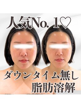 ミタメ 銀座店(MITAME)/ダウンタイムのない脂肪燃解◎