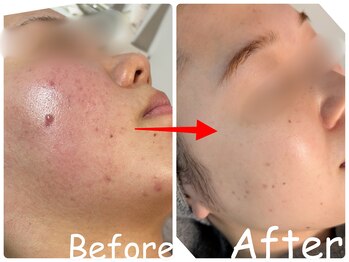 エレ(ele)の写真/【プロの知識で結果にコミット！】検定資格を持つ専門家と二人三脚で、あなた史上最高の美肌を叶える☆