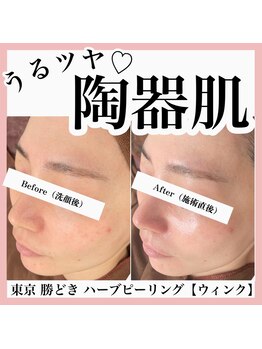 ウィンク 勝どき(wink)/ハーブピーリング