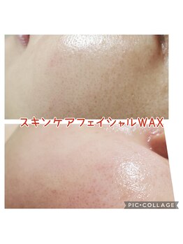 ハナ(HANA)/本来の肌の色へ