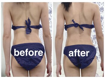 ハロ 南青山(HALO)/上半身キャビテーションラジオ波