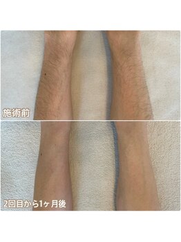 リノ沼津(Lino)/腕脱毛　2回目から1ヶ月後