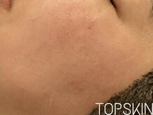 トップスキン 栄(TOPSKIN)/肌質改善/肌管理はTOPSKINへ♪